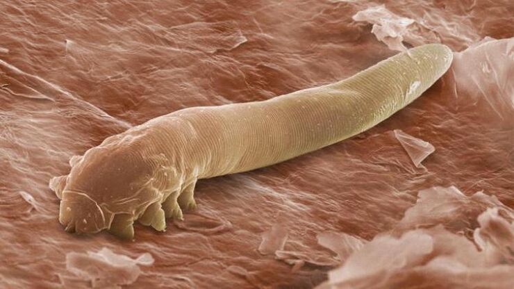 worm living under human skin