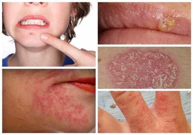 Allergies and skin conditions are signs of parasites in the body