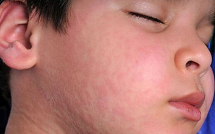 Allergic skin rashes - a symptom of the presence of parasitic worms in the body